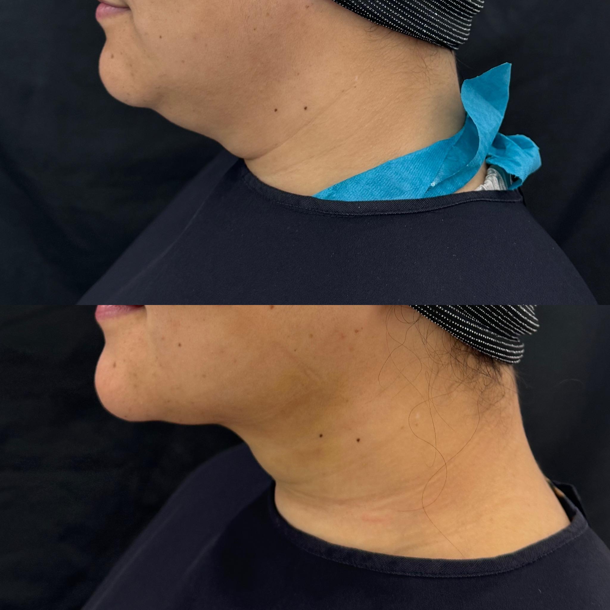 Neck area comparison showing contour refinement